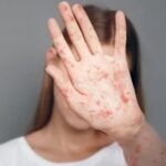 Alerta por sarampión