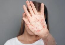 Alerta por sarampión